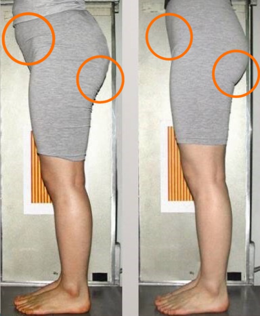 O脚矯正のbefore・after
結果